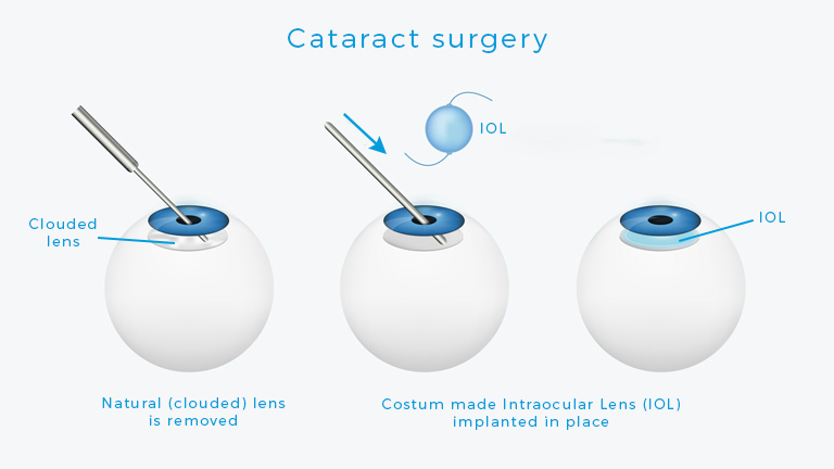 Best cataract treatment and surgery in Europe Betamedics